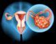 Chist ovarian: simptome, cauze, tratament 